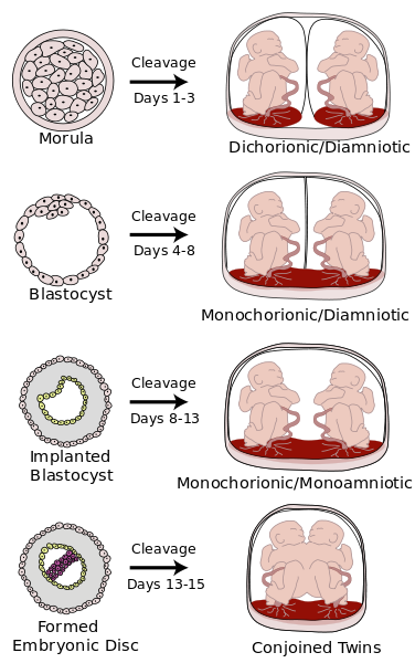 Quatre types de jumeaux monozygotes.